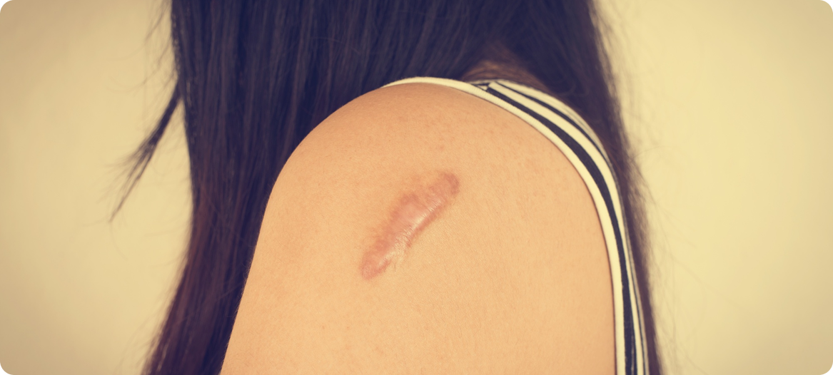 Scar Management - Dr Moataz Soliman