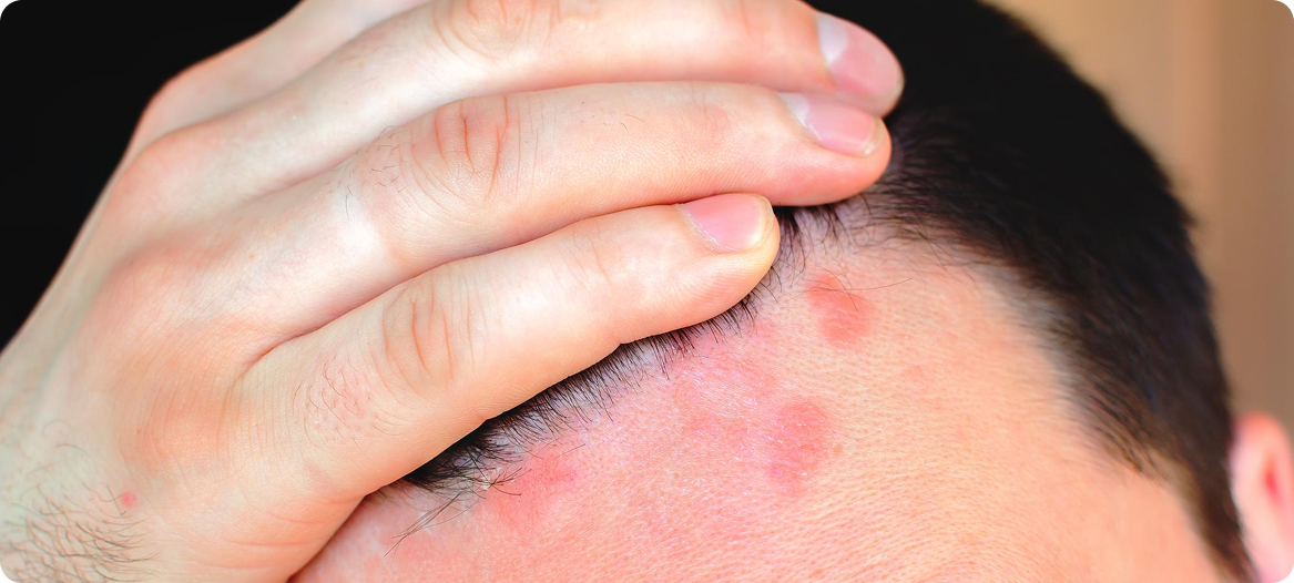 Sobril Rash Seborrheic Dermatitis Treatment - Dr Moataz Soliman