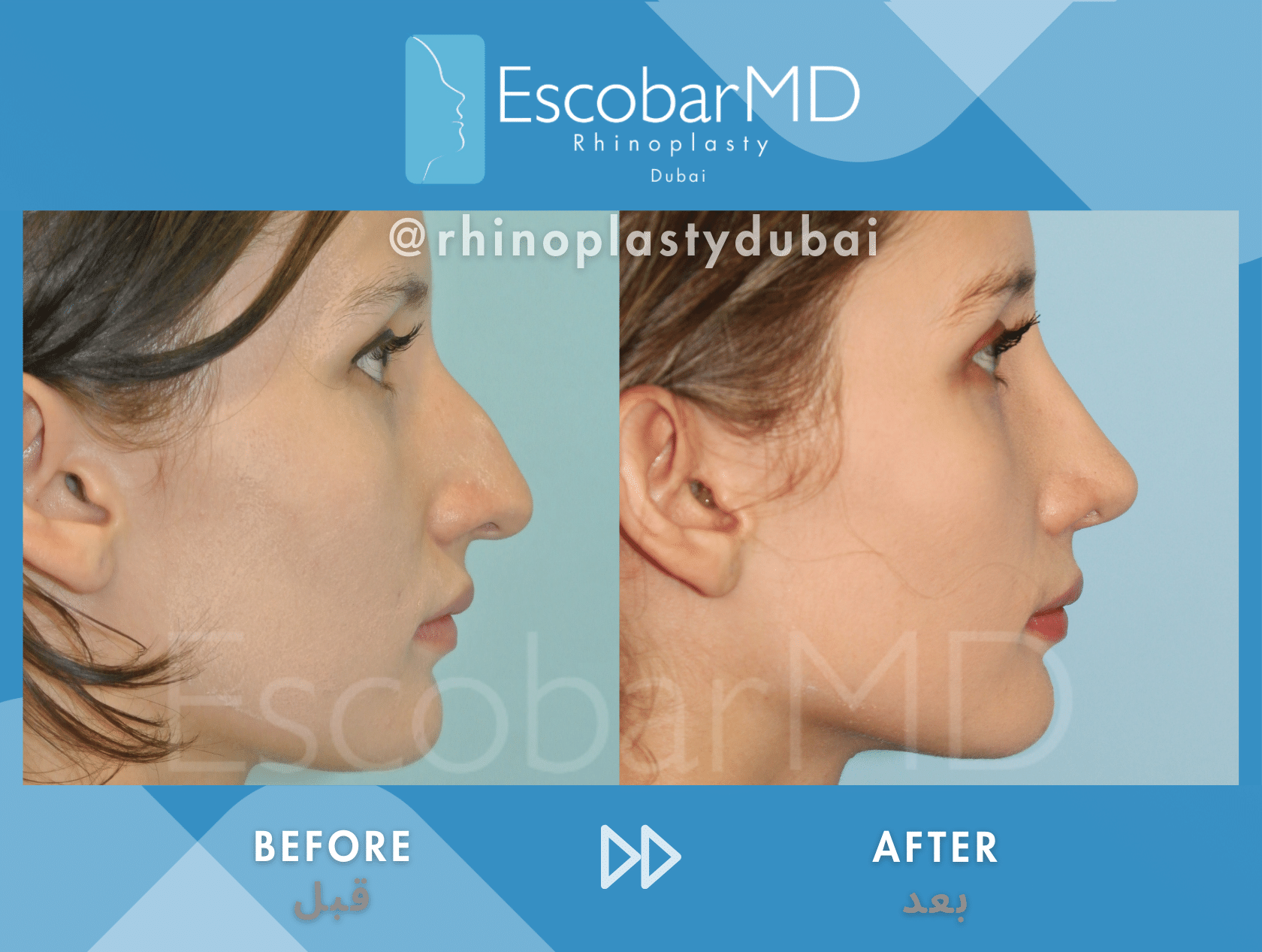 Case 02 Primary Septo-rhinoplasty Right Profile View